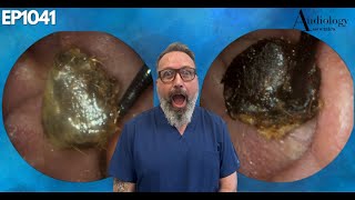 The Most Shocking Ear Wax Removal Youve Never Seen  EP1041 [upl. by Ariaic138]