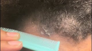 Dandruff removal on hairline [upl. by Arikaahs628]