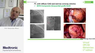 Anaortic notouch OPCAB and how to do it Lecture by Professor Alexander Albert [upl. by Lothario]