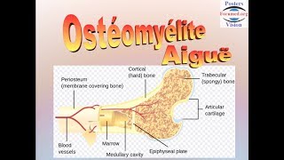 Ostéomyélite aiguë hematogene [upl. by Akinahs]