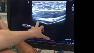 IGHL adhesive capsulitis ultrasound [upl. by Omer]