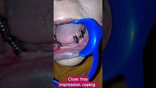 Implant impression using close tray impression coping dentalcafe4331 [upl. by Eveleen]