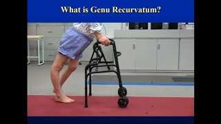 Genu recurvatum treated with Rotating Hinged Knee 무릎이 뒤로 꺾이는 환자에게 시행한 RHK 임플란트를 이용한 인공관절 수술 [upl. by Hulen]