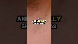 Shingles ALERT Dont Ignore These 10 Warning Signs [upl. by Htiel]