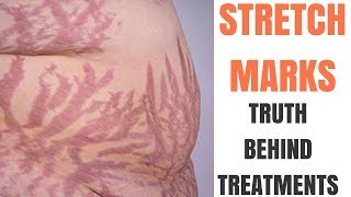 Stretch Marks Inkless Removal Boleyn Treatment Los Angeles 🌍 shorts [upl. by Notyep907]