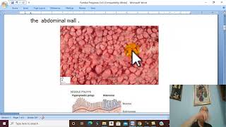 Intestinal Disorders in Arabic 11 Familial Polyposis Coli   by Dr Wahdan [upl. by Adams]