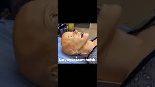 Laryngospasm notch  Larsons point  Stridor ✓ Jaw thrust maneuver ✓ shortvideo [upl. by Ddart]