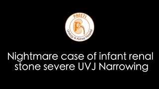 Nightmare case of infant renal stone severe UVJ Narrowing [upl. by Halsy]