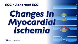 ECG 29  Changes in Myocardial Ischemia [upl. by Anwadal]