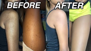 How To Get Rid Of Dark Spots On Your Body  Natural Remedies [upl. by Dowlen]