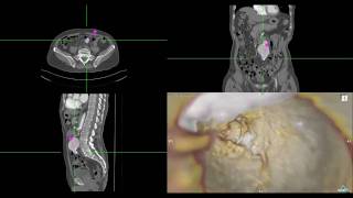 Abdominal Aortic Aneurysm Endoscopie Navigated [upl. by Scevour]