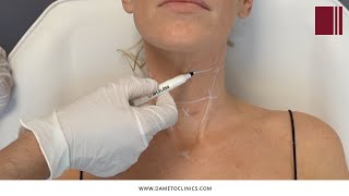 Profhilo Bio Aesthetic Points BAP Neck Technique explained by Dr Gabriel Siquier [upl. by Devinna626]