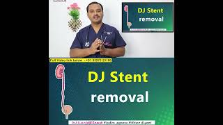 Ureteric Double J stent Removal [upl. by Melloney]