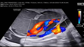 VSUM08092020CLS14 Placental Chorioangioma [upl. by Nic34]