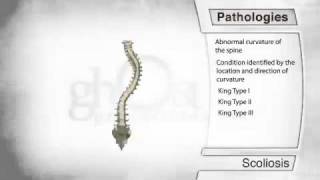 Scoliosis Pathology [upl. by Refenej941]