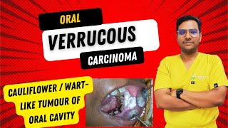 Dr Rudra Mohan  Oral Verrucous CarcinomaCauliflower WartLike Tumour of the Oral Cavity  OVC [upl. by Namrej]