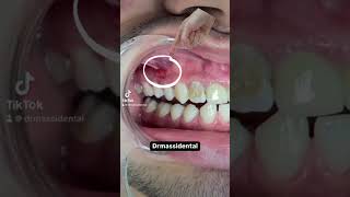 Dental infection  fistula [upl. by Buseck]