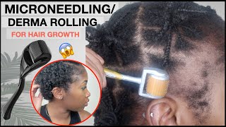 MICRONEEDLINGDERMA ROLLING FOR EDGE GROWTH  Two Month Update  TRACTION ALOPECIA 🚨 NO MINOXIDIL [upl. by Nnylyoj]