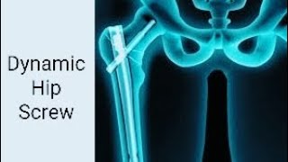 Dynamic Hip Screw Surgical Technique and Rehabilitation Tips [upl. by Markland]