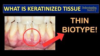 Gingival Recession Treatment How to Check the Keratinized Gingival Tissue Periodontal Maintenance [upl. by Khorma104]