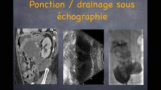 Pancréatite aiguë  3 Diagnostic des complications [upl. by Ailam273]