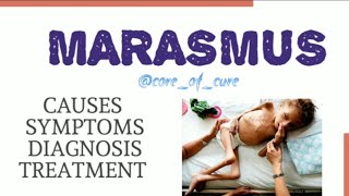 MARASMUS  CAUSES  SYMPTOMS  DIAGNOSIS  TREATMENT [upl. by Hoang]