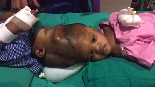 Indian doctors separate twins joined at the head [upl. by Diarmit243]