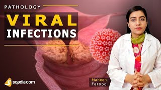 Viral Infections  Mumps  Pathology Video Lectures  Medical VLearning  sqadiacom [upl. by Yancy]