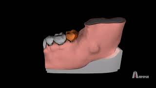 Animation  Dentigerous Cyst 3D Model [upl. by Mays188]