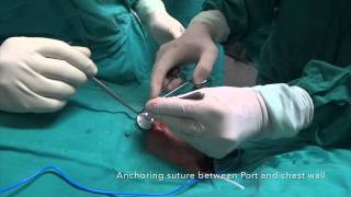 Port A Cath Implantation [upl. by Aikit]