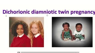 Anatomy of dichorionic and diamniotic twin pregnancy with sonographic feature twin obimagesnet [upl. by Alik]