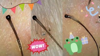 Satisfying Hair Follicle Plucks Big Roots Hair Extraction Under Microscope [upl. by Schroth306]