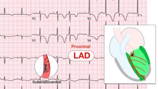 Ischemia 57 Examples of UA and NSTEMI [upl. by Collar434]