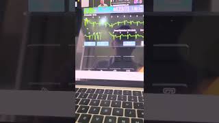 Cardioversi VT ventricular tachycardia monomorpic ke SR sinus rhythm gakur viralvideo cardio [upl. by Kcirted]