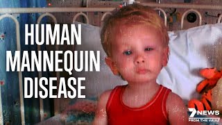 Worlds Rarest Disease The Human Mannequin  Documentary [upl. by Enyahc]