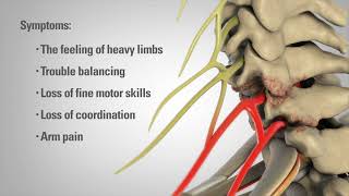 Cervical Laminectomy  Patient Animation [upl. by Itch]