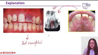 NEET MDS 2024 Endo  Odontoclastoma [upl. by Perr]