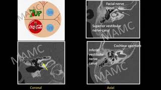 TMT Inner Ear by Dr Jyoti Kumar  Part II [upl. by Nanreik998]