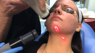 Recovery After CO2 Laser Facial [upl. by Nirrat]