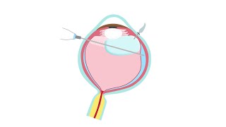 Retinal Detachment Treatment—Pars Plana Vitrectomy [upl. by Hannahs]