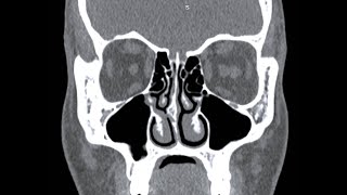 How to read a CT PNS  All points Explained in detail [upl. by Bernie]