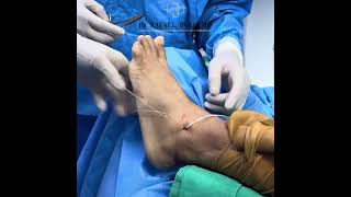 Combined Medial and Lateral Augmentation Ligament Reconstruction of the Ankle 100 PERCUTANEOUS [upl. by Dugaid]