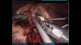 ROBOTIC ANATOMICAL RIGHT HEPATECTOMY AND DISTAL PANCREATECTOMY FOR OLIGOMETASTATIC PANCREAS ADENOCAR [upl. by Alveta]