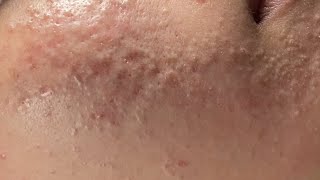 Acne Treatment Huong Da Nang  2024 acne608 [upl. by Lydia]