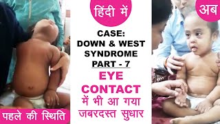 Down Syndrome amp West Syndrome Case  Part 7  EYE CONTACT में भी आ गया जबरदस्त सुधार  हिंदी मे [upl. by Sachsse401]