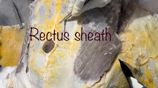 Rectus Sheath  dissection [upl. by Okihsoy]