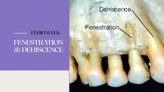 PERIO WEEK 📚  FENESTRATION amp DEHISCENCE [upl. by Putnam]