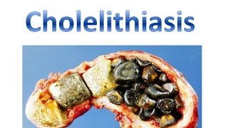 Cholelithiasis [upl. by Podvin73]