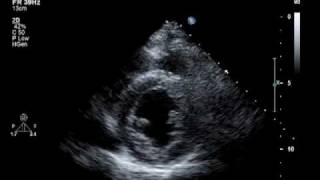 Hypokinesis Mitral Regurgitation Aortic Insufficiency [upl. by Dolores410]