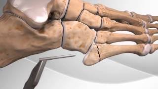 Metatarsal Fracture Repair with Arthrex® Jones Screw [upl. by Matland]